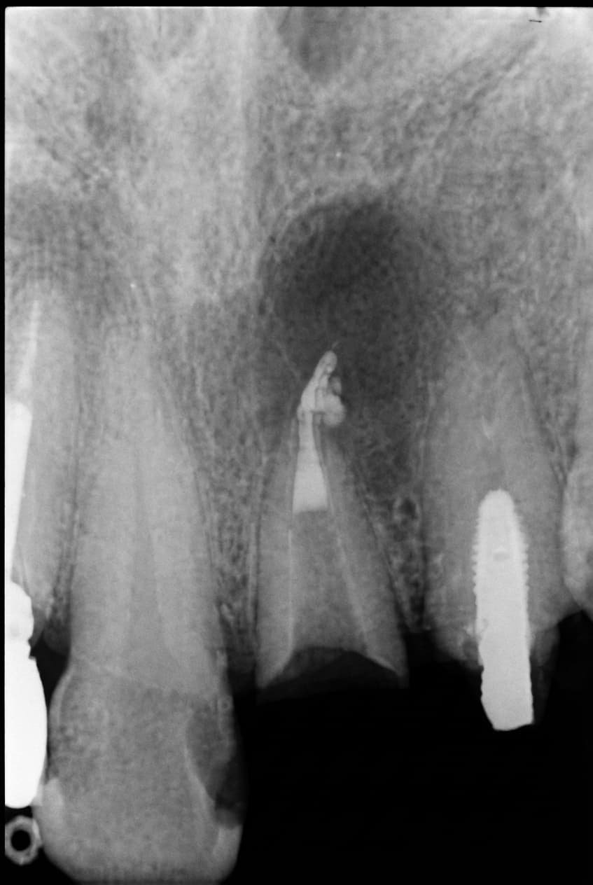 根管治療 症例 3