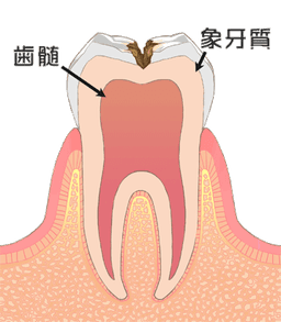 C2 象牙質の虫歯の断面図