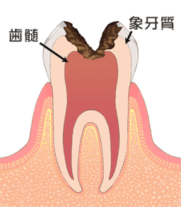 C3 歯髄炎の断面図