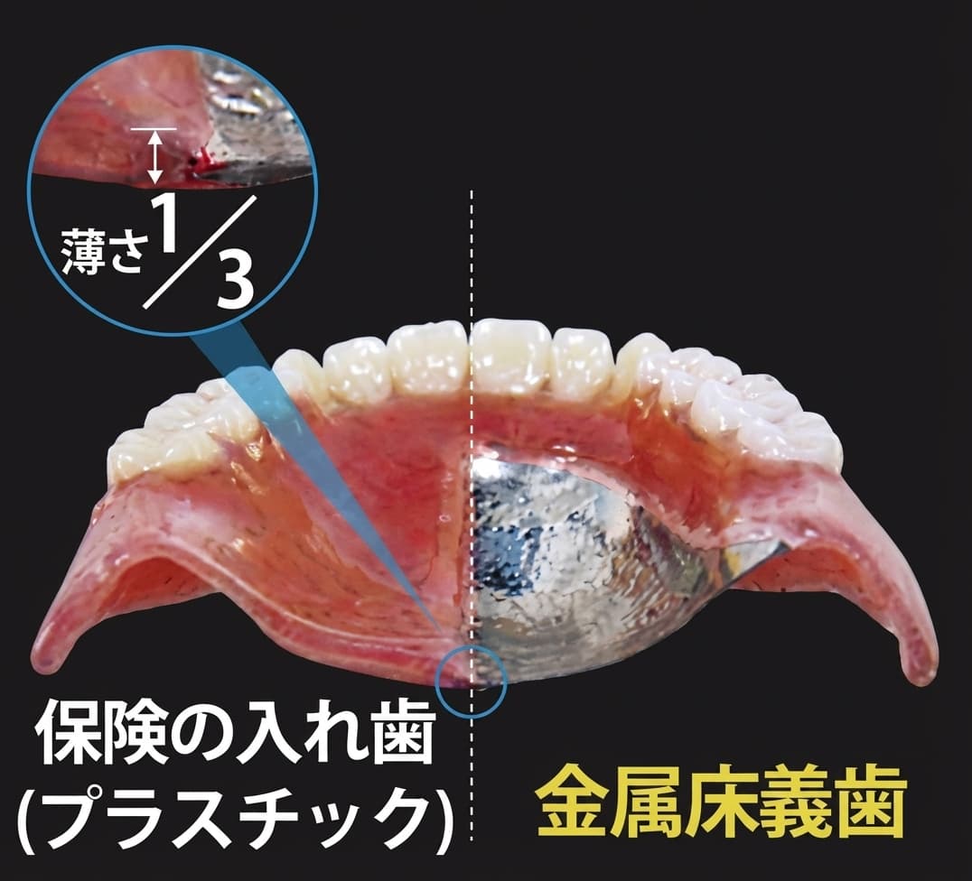 保険の入れ歯(プラスチック)と金属床義歯の厚さ比較