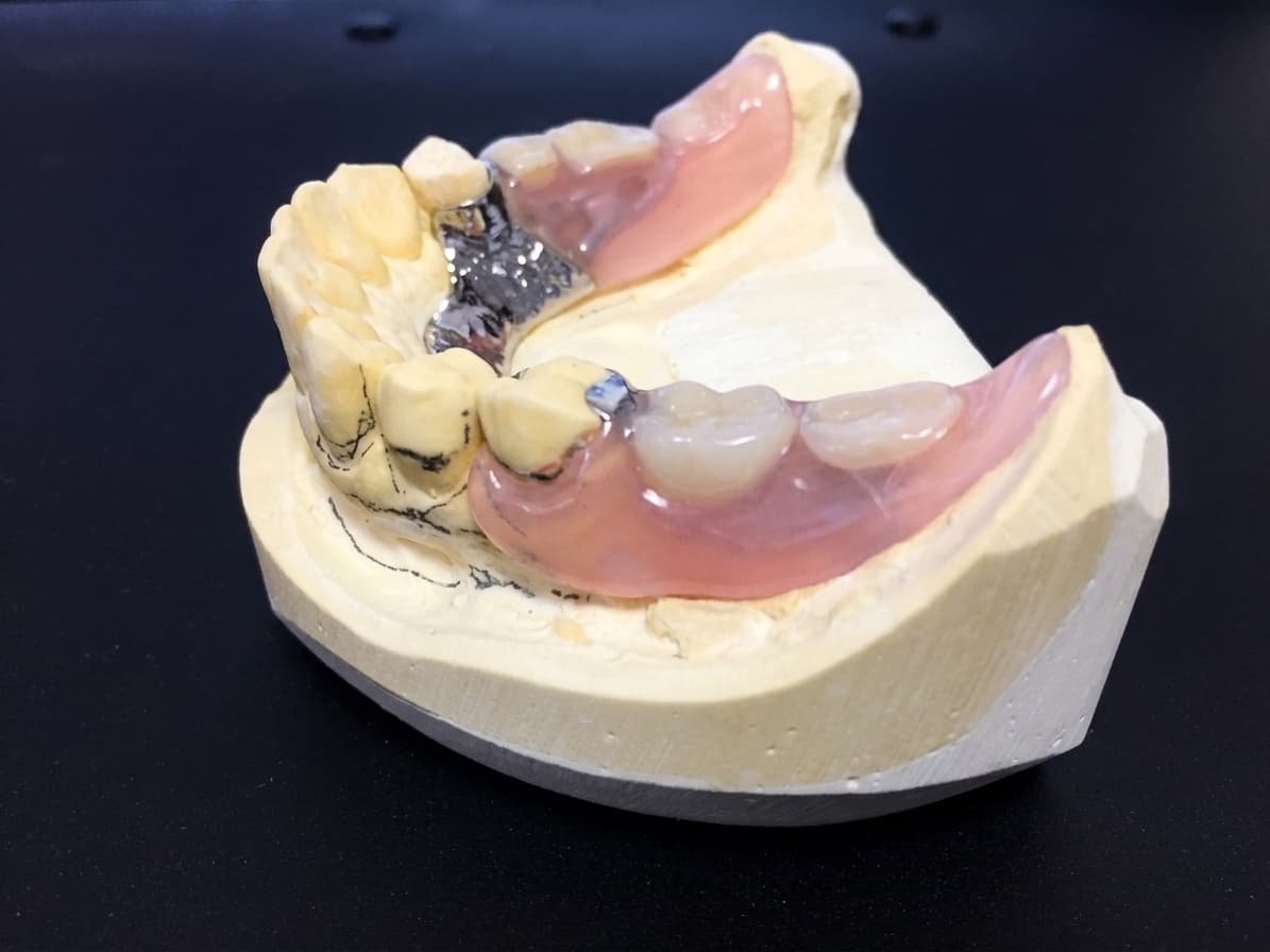 ノンクラスプデンチャーを模型に装着した様子 症例1